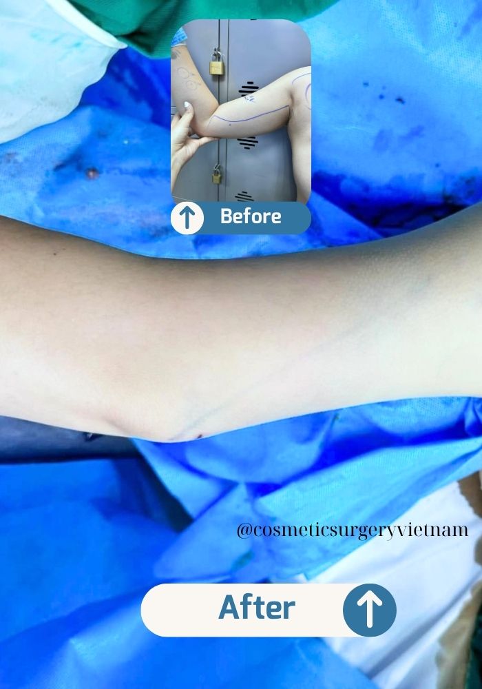 Before (1) Before 1 1